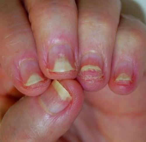 Ямки на ногтях руки. Классификация и симптомы линий Бо 07