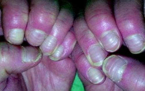 Ямки на ногтях руки. Классификация и симптомы линий Бо 02