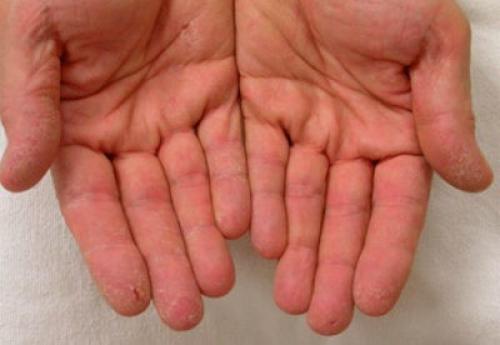 Трескается кожа около ногтей на пальцах рук. Почему трескается кожа рук?