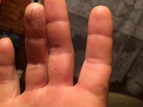 Трескается кожа около ногтей на пальцах рук. Почему трескается кожа рук?