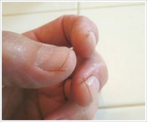 Какие средства и методы лечения наиболее эффективны для трещин и трескания кожи вокруг ногтей на руках. Внутренние факторы