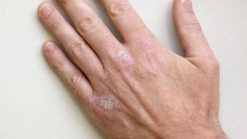 Способы ухода за сухим и огрубевшим кожей вокруг ногтей на руках 01 Способы ухода за сухим и огрубевшим кожей вокруг ногтей на руках 01