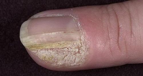 Можно ли использовать мази или кремы для лечения потрескивающейся кожи возле ногтя на руке. Трещины возле ногтей на руках — причины и лечение