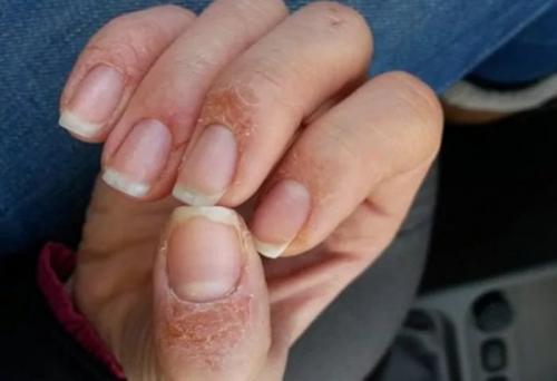 Какие гель-лаки не вызывают гиперреакции. Может ли быть гиперчувствительность на гель-лак? 02