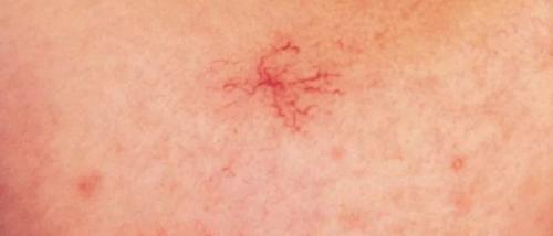 Что такое гемангиома и как она лечится. Классификация 09