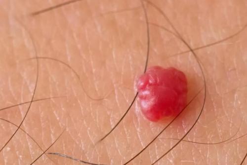 Что такое гемангиома и как она лечится. Классификация 10