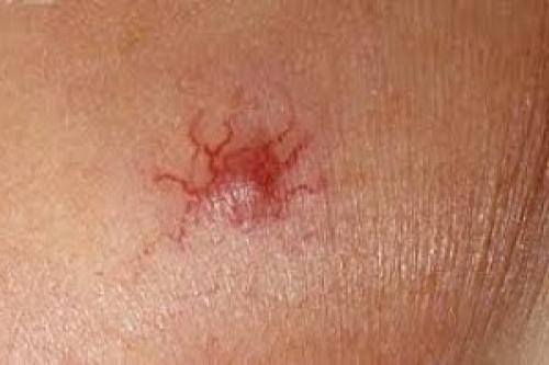 Что такое гемангиома и как она лечится. Классификация 04