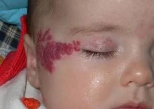 Гемангиома у детей и взрослых. Гемангиома у детей и новорожденных – общая характеристика 03 Гемангиома у детей и взрослых. Гемангиома у детей и новорожденных – общая характеристика 03