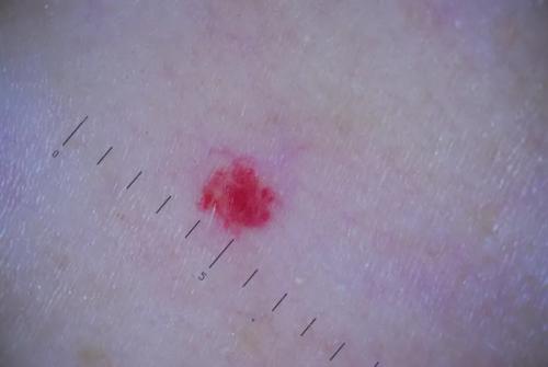 Гемангиома у детей и взрослых. Гемангиома у детей и новорожденных – общая характеристика 05 Гемангиома у детей и взрослых. Гемангиома у детей и новорожденных – общая характеристика 05