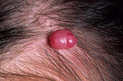 13 фактов о младенческой гемангиоме. Гемангиома у детей 13 13 фактов о младенческой гемангиоме. Гемангиома у детей 13