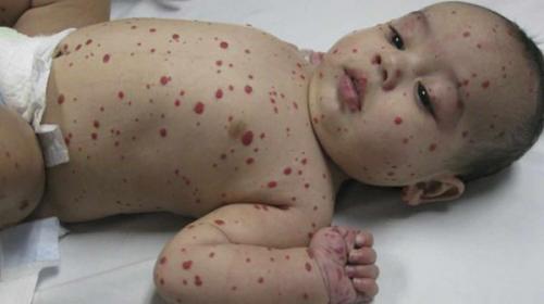 13 фактов о младенческой гемангиоме. Гемангиома у детей 01 13 фактов о младенческой гемангиоме. Гемангиома у детей 01