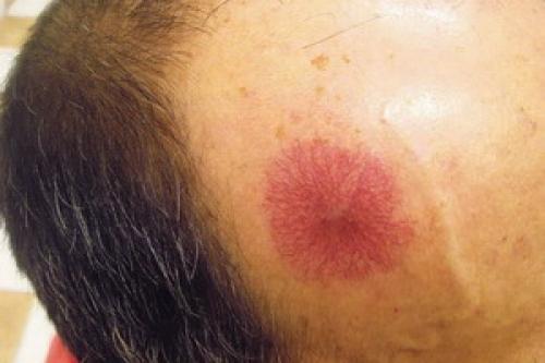 13 фактов о младенческой гемангиоме. Гемангиома у детей 05 13 фактов о младенческой гемангиоме. Гемангиома у детей 05