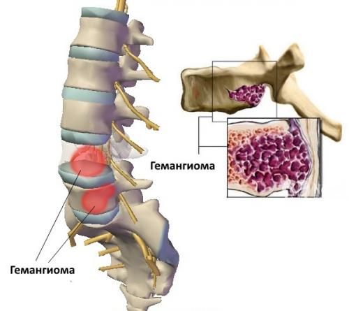 Размеры гемангиомы позвоночника для операции. Вертебропластика гемангиомы позвоночника