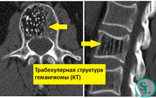 Гемангиома грудного отдела позвоночника. Причины образования гемангиомы
