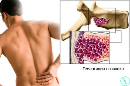 Гемангиома грудного отдела позвоночника. Причины образования гемангиомы