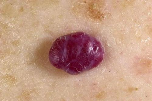 Гемангиома позвоночника и баня. Красные родинки – гемангиомы: причины появления на теле и виды