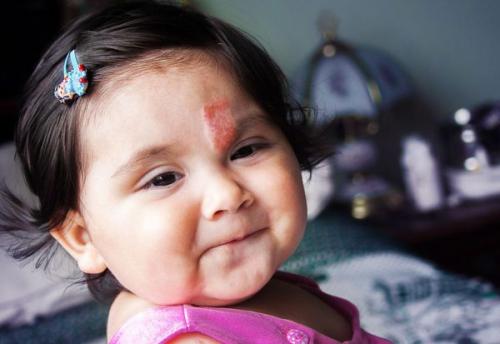 Лечение младенческих гемангиом у детей без операции. Гемангиома у детей 11 Лечение младенческих гемангиом у детей без операции. Гемангиома у детей 11