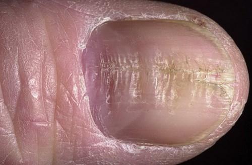 Деформация ногтевой пластины причины. Причины, симптомы и разновидности патологии 08 Деформация ногтевой пластины причины. Причины, симптомы и разновидности патологии 08