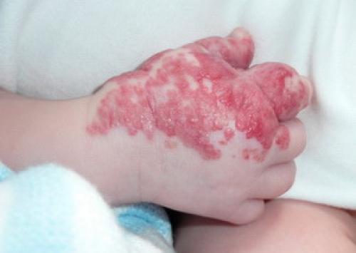 Все о младенческих гемангиомах. 13 фактов о младенческой гемангиоме 04