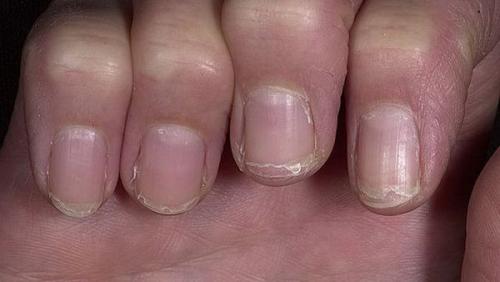 Деформация ногтевой пластины причины. Причины, симптомы и разновидности патологии 01 Деформация ногтевой пластины причины. Причины, симптомы и разновидности патологии 01