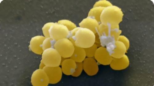 Паронихия ногтя. Паронихия