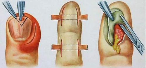Панариций у ногтя на ноге. Панариций. Виды панариция, методы лечения 01 Панариций у ногтя на ноге. Панариций. Виды панариция, методы лечения 01