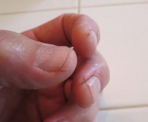 Можно ли использовать лосьон для избавления от трескающейся кожи вокруг ногтей. Чем и как лечить трещины на руках?