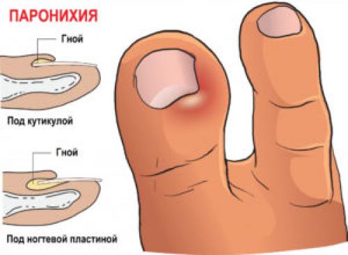 Нарывает палец после маникюра. Опасность маникюра 05 Нарывает палец после маникюра. Опасность маникюра 05