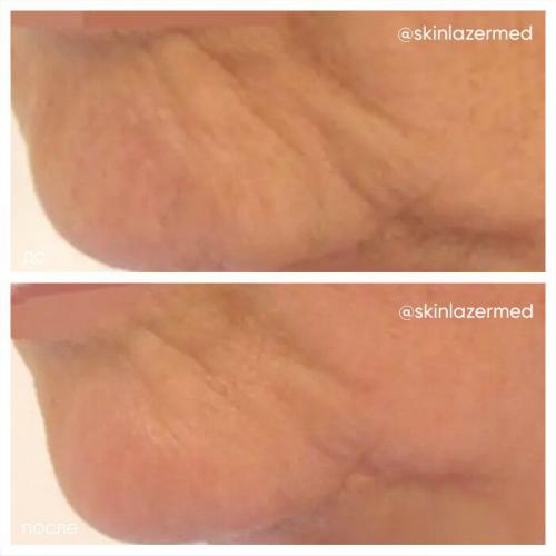 РФ-лифтинг: протокол процедуры. РФ лифтинг лица