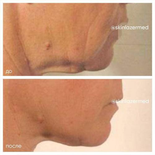 РФ-лифтинг: протокол процедуры. РФ лифтинг лица