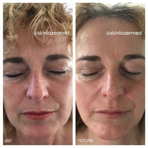 РФ-лифтинг: протокол процедуры. РФ лифтинг лица