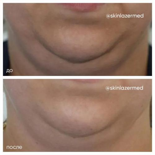 РФ-лифтинг: протокол процедуры. РФ лифтинг лица