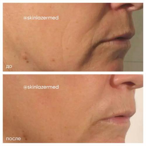 РФ-лифтинг: протокол процедуры. РФ лифтинг лица