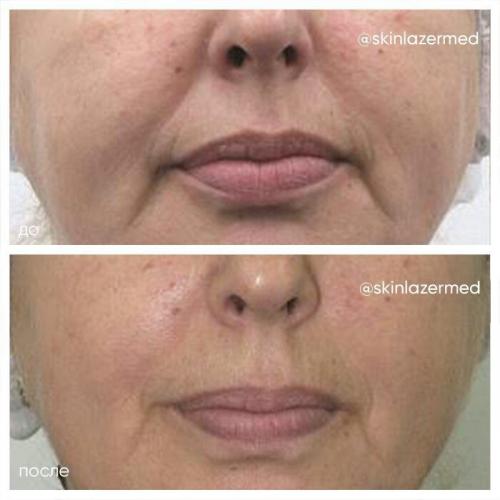 РФ-лифтинг: протокол процедуры. РФ лифтинг лица