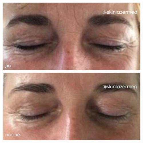 РФ-лифтинг: протокол процедуры. РФ лифтинг лица