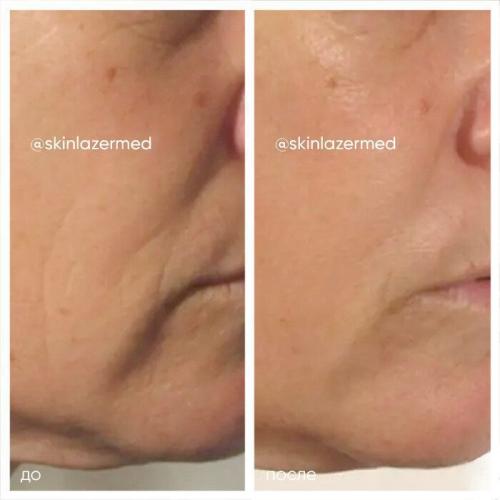 РФ-лифтинг: протокол процедуры. РФ лифтинг лица