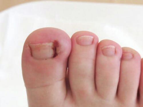 Вросший ноготь у ребенка лечение в домашних условиях. Что делать, если у ребенка врастает ноготь на руке или ноге?