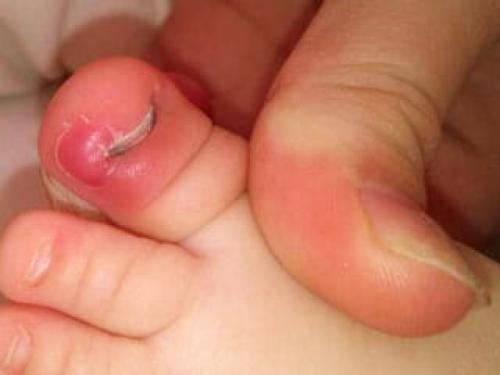 Вросший ноготь у ребенка лечение в домашних условиях. Что делать, если у ребенка врастает ноготь на руке или ноге?