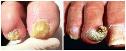 Деформация ногтевой пластины подолог. Забудьте о врастающих ногтях с «Ego Estetic®»! 04 Деформация ногтевой пластины подолог. Забудьте о врастающих ногтях с «Ego Estetic®»! 04