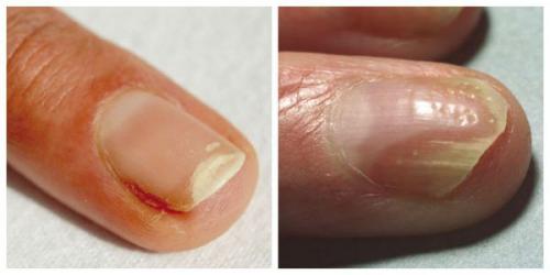 Деформация ногтевой пластины подолог. Забудьте о врастающих ногтях с «Ego Estetic®»! 03 Деформация ногтевой пластины подолог. Забудьте о врастающих ногтях с «Ego Estetic®»! 03