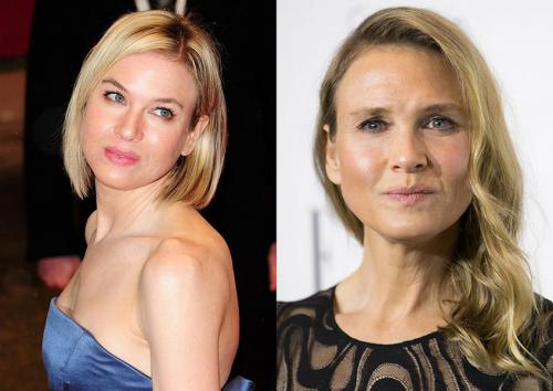 Деми Мур и другие звезды, чью жизнь изменила пластическая хирургия