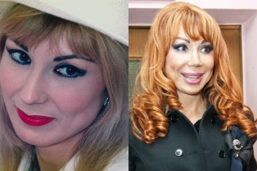 Неудачная пластика звезд россии. Топ 10 советских и российских звезд до после пластики