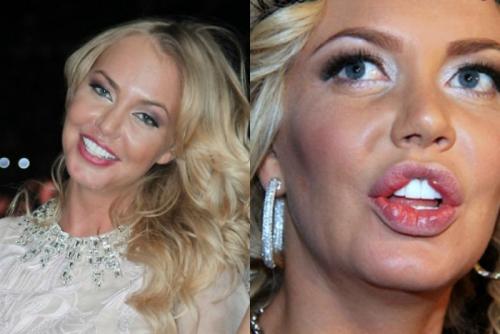 Неудачная пластика звезд россии. Топ 10 советских и российских звезд до после пластики