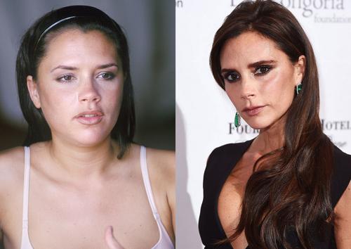 Деми Мур и другие звезды, чью жизнь изменила пластическая хирургия