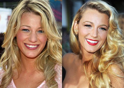 Деми Мур и другие звезды, чью жизнь изменила пластическая хирургия