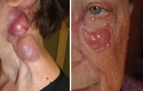 Доброкачественные и злокачественные кожные образования. Общие сведения 02