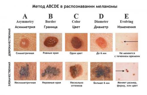 Доброкачественные и злокачественные кожные образования. Общие сведения 01