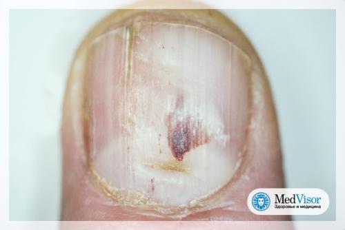 Ногти с ямами. Поперечные линии на ногтях рук: что они означают?