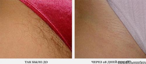 Как удалить волосы в зоне бикини в домашних условиях навсегда. Как навсегда удалить волосы в зоне бикини дома за 5 минут, без боли и бритья!