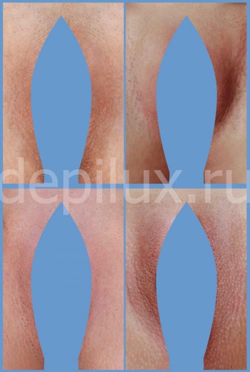 Какая депиляция лучше для зоны бикини. Проведения процедуры в салоне — подготовка, техника выполнения 02